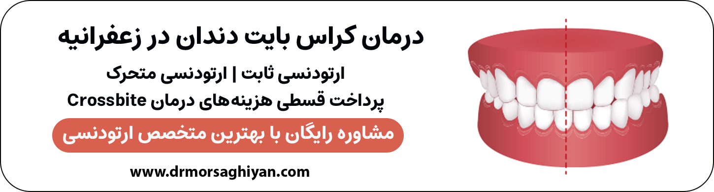 درمان کراس بایت دندان در زعفرانیه تهران | دکتر مرضیه مرساقیان