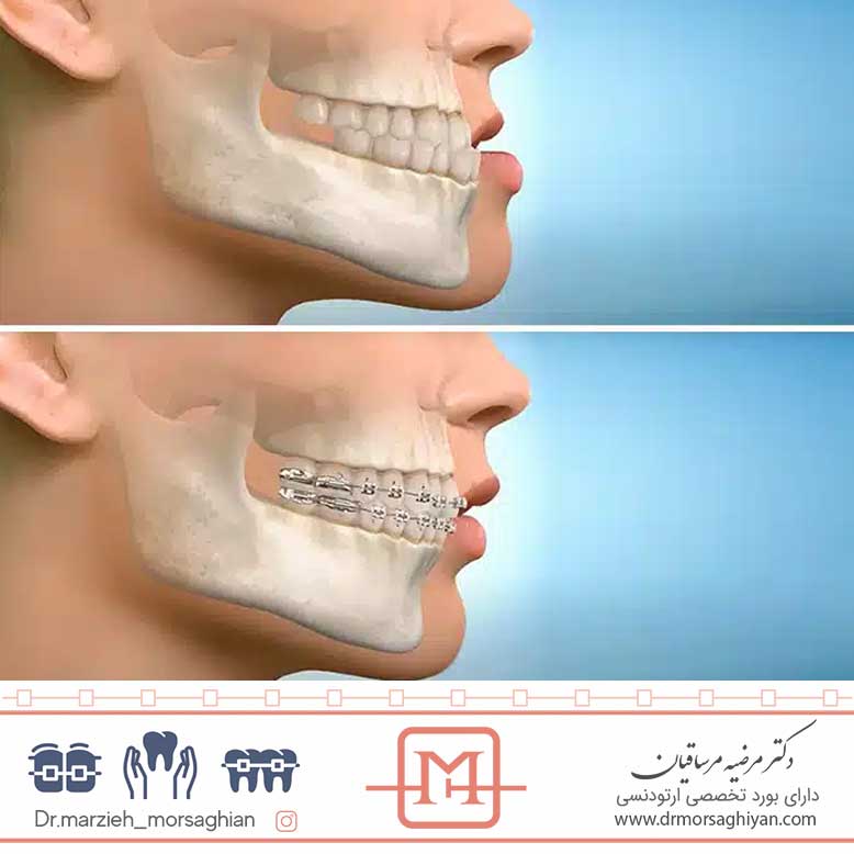 تغییر فرم لب بعد از ارتودنسی چگونه است؟