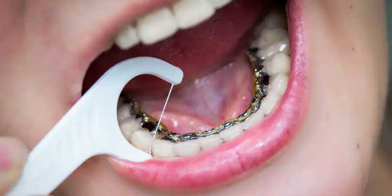 افراد غیرمجاز برای انجام ارتودنسی پشت دندان (لینگوال)