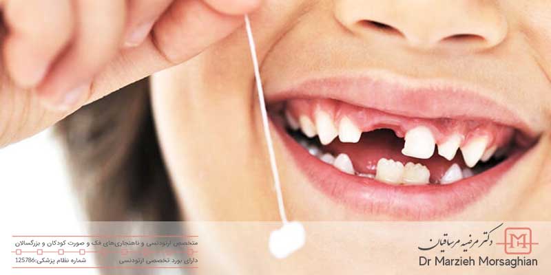 اهمیت دندان‌های شیری در ارتودنسی پیشگیری چیست؟
