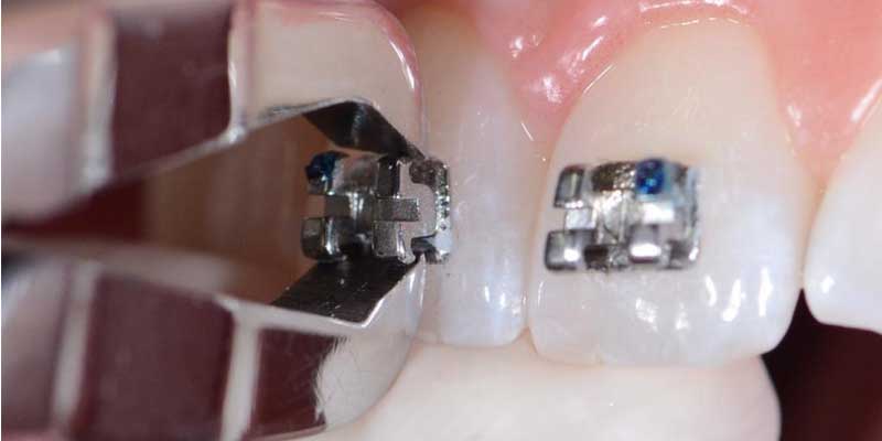 جدا کردن براکت ارتودنسی از روی دندان